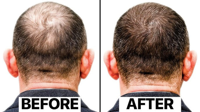 Exosomes For Hairfall and Hairloss