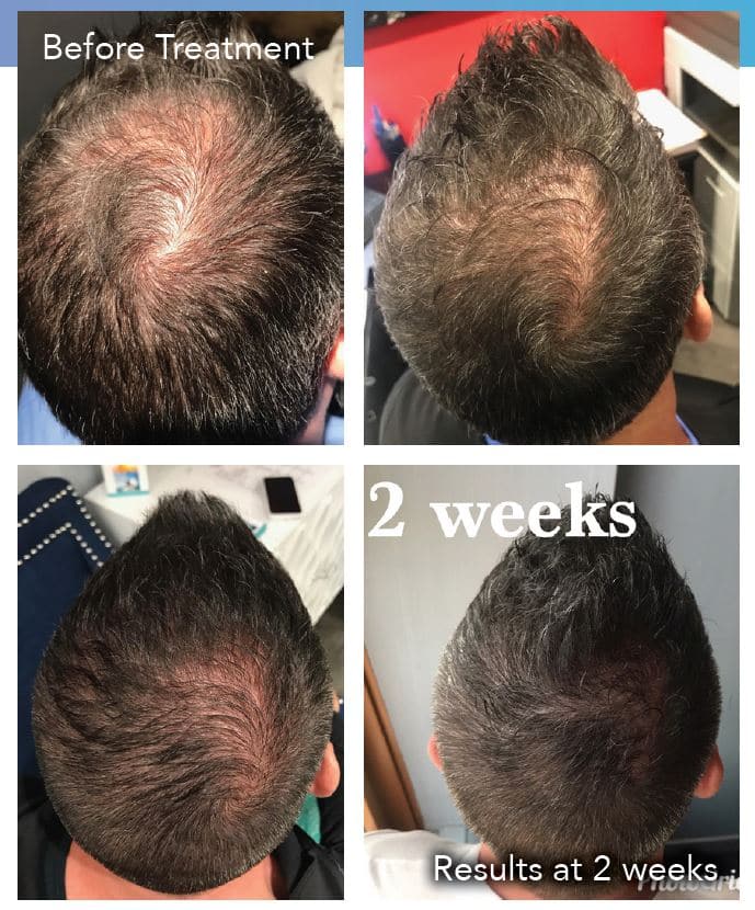 Exosomes For Hairfall and Hairloss
