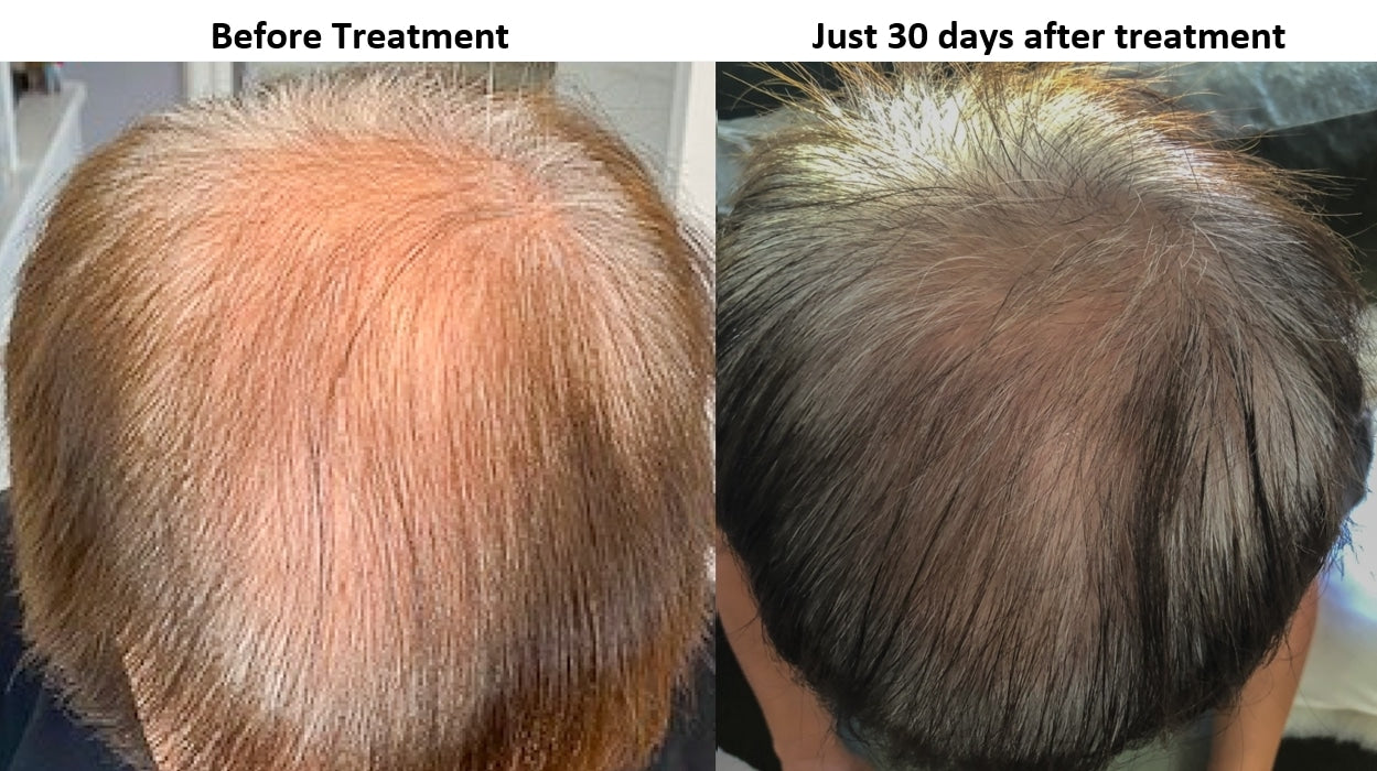 Exosomes For Hairfall and Hairloss