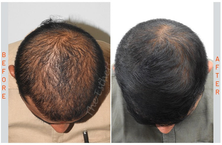 Exosomes For Hairfall and Hairloss