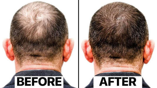 Exosomes For Hairfall and Hairloss